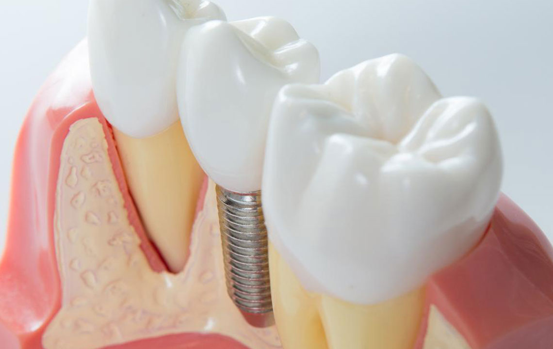 4 practical tips to maintain dental implants for seniors