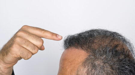 How much do hair transplants cost in the UK