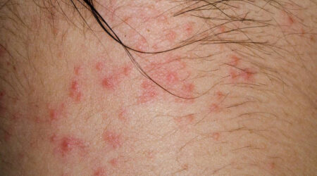 Here are a few common causes of atopic dermatitis