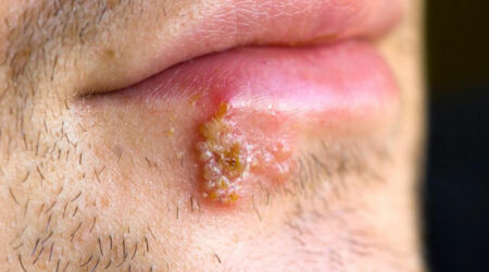 Signs that tell you might have herpes