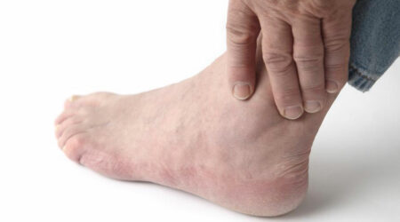 Top Causes of Swollen Ankles