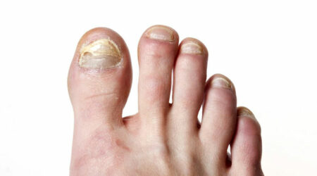 Top signs of toe nail fungus