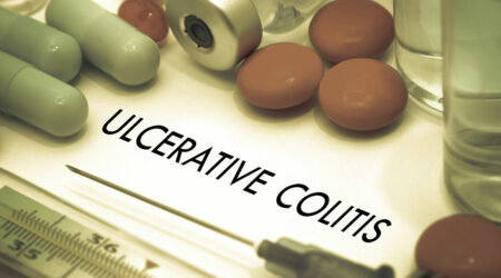 Ulcerative colitis &#8211; Symptoms, causes, and treatment