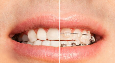 Dental braces &#8211; Types, cost, and insurance coverage