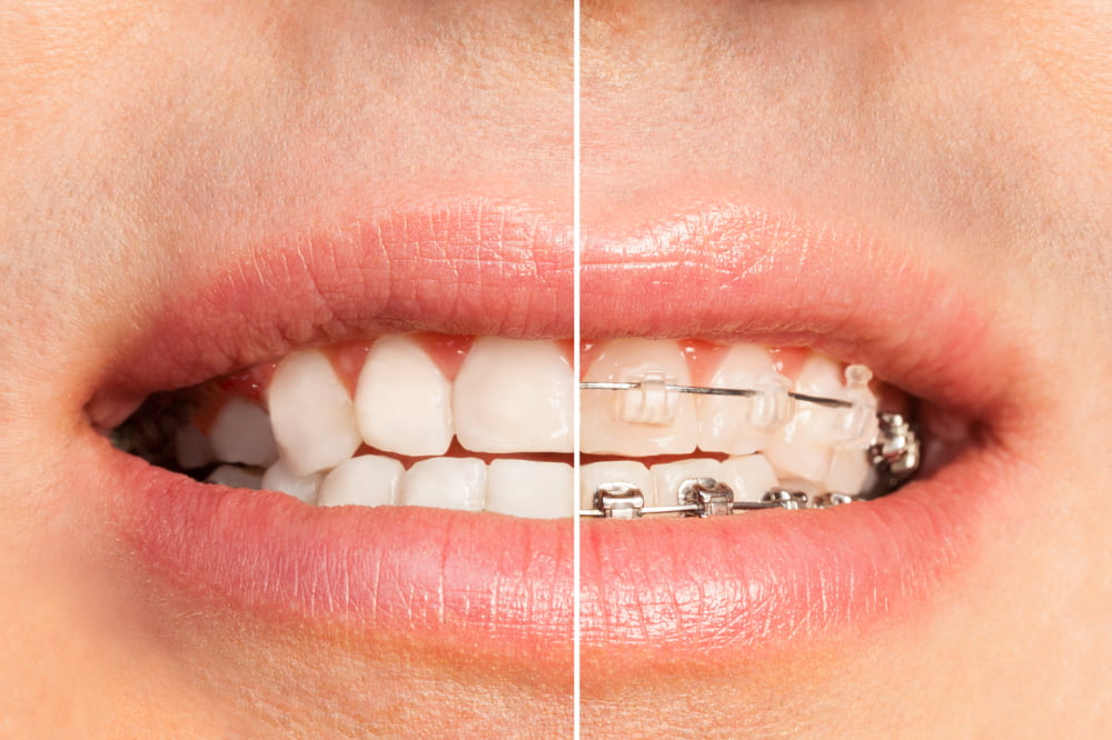 Dental braces &#8211; Types, cost, and insurance coverage