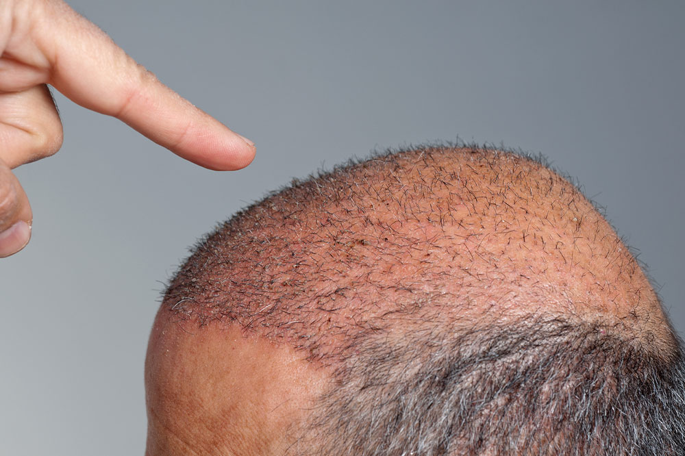 3 popular hair transplants and their cost in India