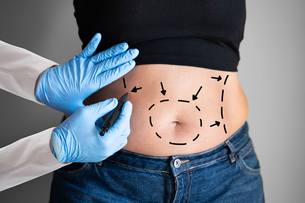 Things to know before opting for an abdominoplasty